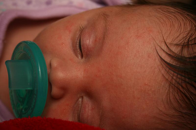 Acneea La Bebelusi 8 IntrebÄƒri Care Ii PreocupÄƒ Pe PÄƒrinÅ£i