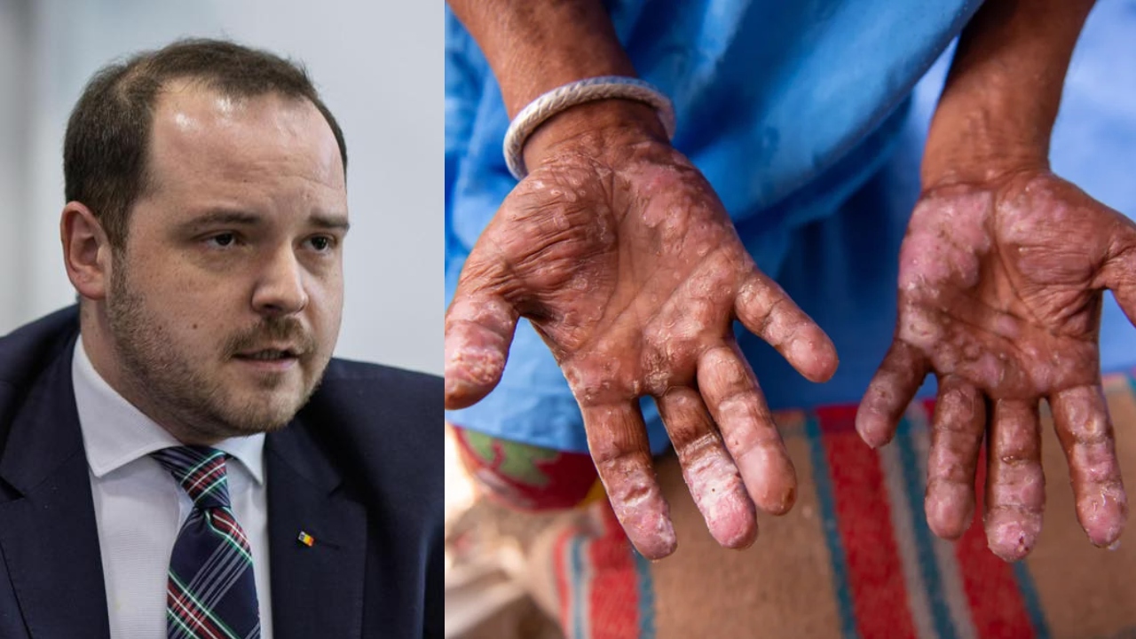 Ministrul Sănătății anunță confirmarea unui caz de lepră la Cluj-Napoca, primul de după 1981