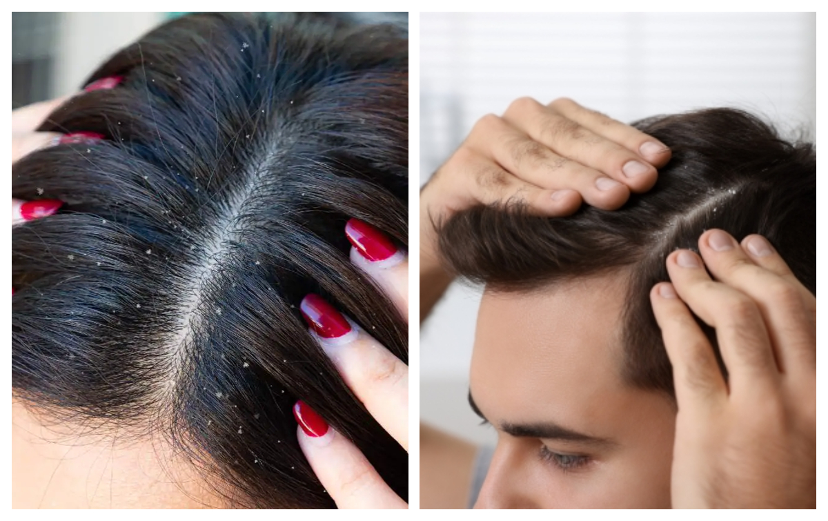 Cele mai bune trucuri care te ajută să scapi de mătreață pentru totdeauna. Ce să faci ca să ai un scalp sănătos