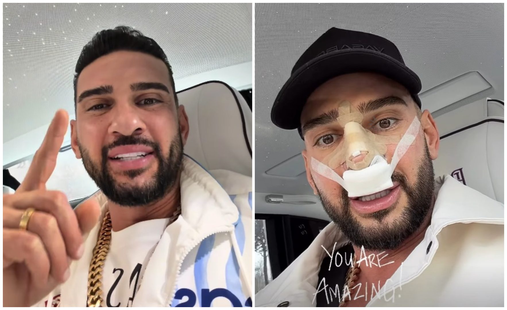 Dorian Popa și-a făcut operație de rinoplastie: „Am o coastă-n nas cum s-ar spune”. Cum se simte vlogger-ul după intervenția chirurgicală