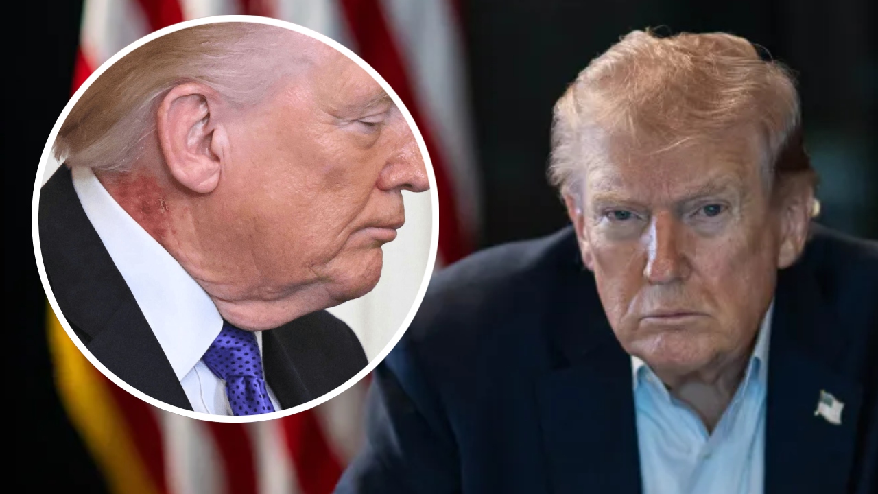 Donald Trump a putut fi văzut cu o erupție cutanată roșie pe gât în prima sa apariție publică de la atacul asupra Iranului. Doctorul Casei Albe explică motivul afecțiunii