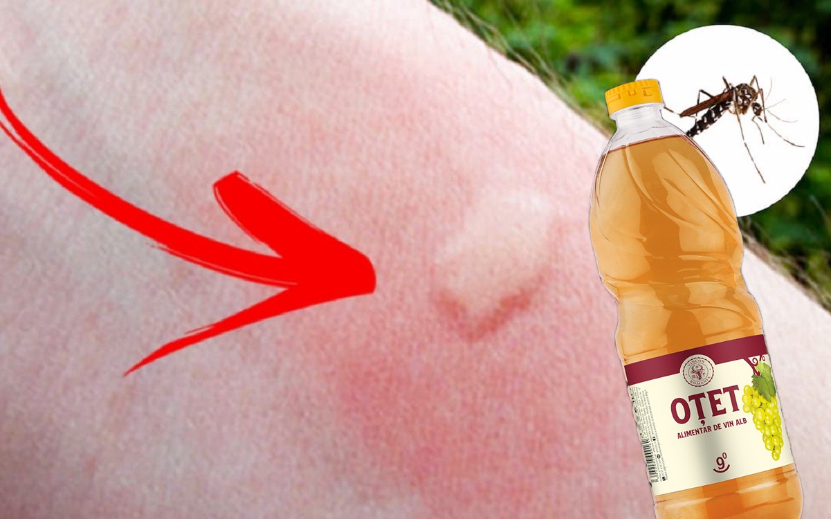 Motivul pentru care se recomandă să aplici oțet pe înțepăturile de țânțar. Remedii naturale rapide care calmează mâncărimile