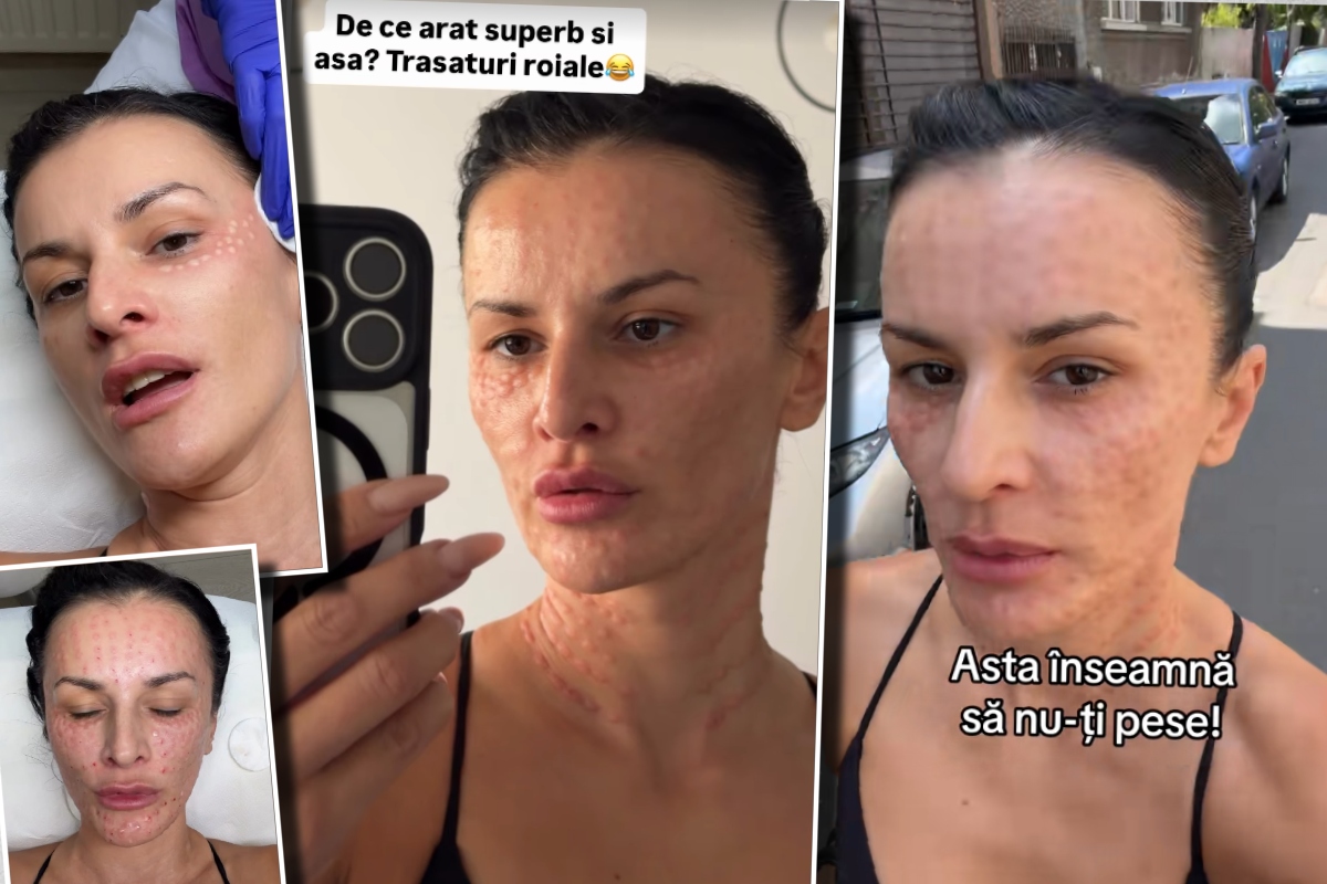 Influencerița Rux și Opulență, apariție șocantă pe stradă după un tratament facial de ultimă generație: „Arăt superb și așa. Am trăsături roiale”. Cât costă procedura