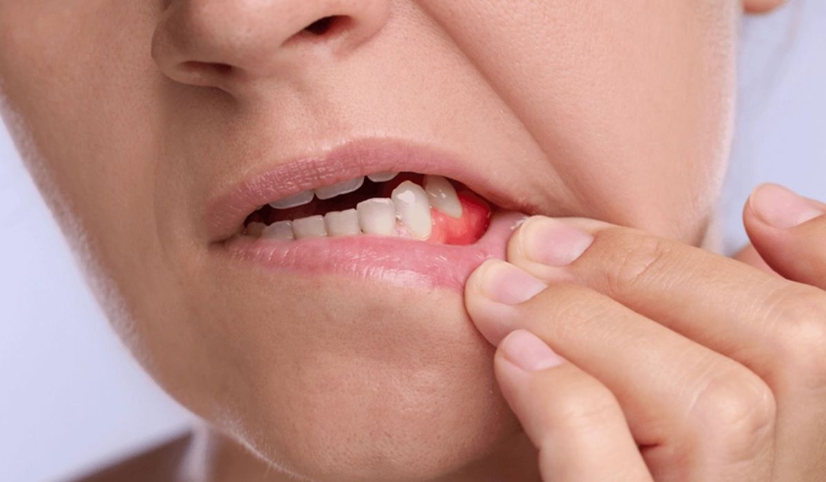 Sângerarea gingiilor: semn banal sau primul indiciu al unei probleme parodontale?